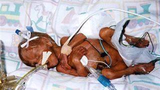 Female Preemies More Likely To Suffer Maternity Woes, Less Likely To Marry